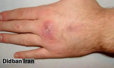 مواد شوینده لباسشویی سد محافظتی پوست را تضعیف می‌کند