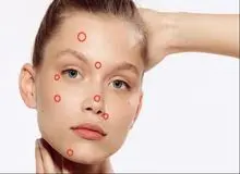 جوش‌های هر نقطه از صورت نشان دهنده چه بیماری هستند؟