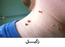زگیل چیست و چگونه درمان می‌شود؟
