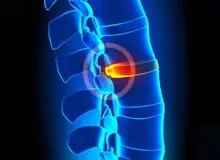 درمان کمردرد مزمن بدون جراحی ممکن شد