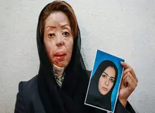 پرونده قربانیان اسیدپاشی های اصفهان مختومه شد
