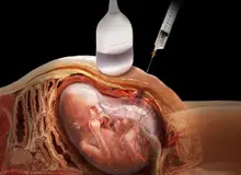 ماجرای حضور فقها در شورای جدید سقط جنین چیست؟