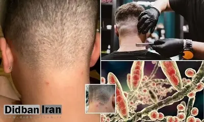 هشدار آرایشگران درباره افزایش موارد قارچ پوستی