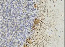 نشانه‌های خونی ممکن است ابتلای به ام‌اس را تا هفت سال پیش از بروز علائم پیش‌بینی کنند