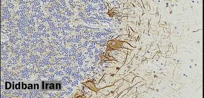 نشانههای خونی ممکن است ابتلای به اماس را تا هفت سال پیش از بروز علائم پیشبینی کنند