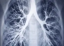 سرطان ریه، شایع‌ترین و کشنده‌ترین سرطان در جهان