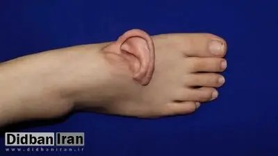 گوش برای اولین بار به پا پیوند زده شد