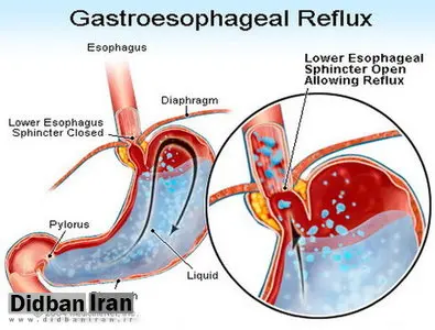 برگشت غذا از معده به مری را چگونه کنترل کنیم؟