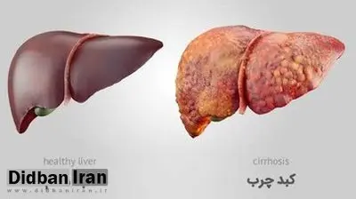 خوراکیهای مفید و مضر برای کبد را بشناسید+اسامی