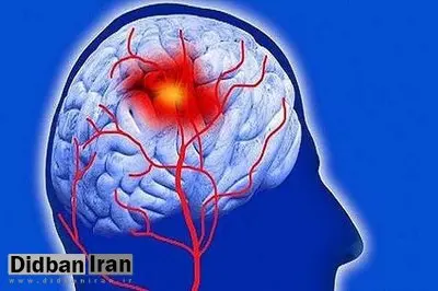 افزایش نرخ سکته مغزی در بین جوانان