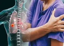 تشخیص سرطان ریه از طریق نحوه راه رفتن+جزییات 