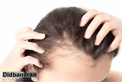چهار توصیه مهم برای کسانی که ریزش مو دارند