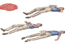  بی‌تأثیری داروهای گیاهی در درمان صرع