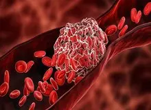 چربی خون بالا؛ دشمن خاموش رگ‌ها