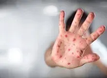 آخرین وضعیت ۶ بیمار مشکوک به آبله میمونی؛ جواب تست ۴ نفر منفی شد / ۲ مورد همچنان در حال بررسی