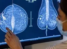 زنان استرالیایی به دنبال برداشتن پروتز پستان