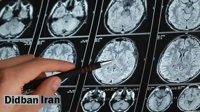 پیشگیری از آلزایمر از امروز آغاز میشود، نه بعد از ۶۵ سالگی