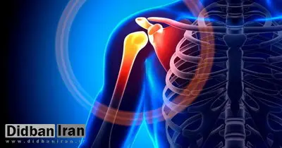 شانه یخ‌زده چیست؟
