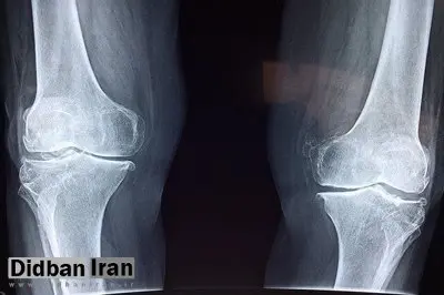 تشخیص علائم اولیه پوکی استخوان با هوش مصنوعی