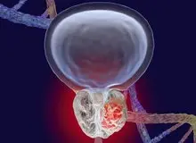 علت شایع شدن سرطان پروستات در ایران چیست؟