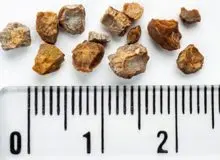 پنج درمان خانگی برای تسکین درد سنگ کلیه؛ از سیر تا آب ریحان