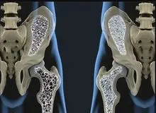 ۳ خطر بزرگ پوکی استخوان که کمتر کسی می‌داند