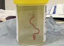 برای اولین بار در جهان؛ خارج کردن کرم زنده ۸ سانتی‌متری از مغز یک زن