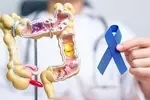 یافته‌های جدید درباره پیشگیری از سرطان روده