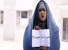 معروف‌ترین قربانی اسیدپاشی: هنوز دیه‌ام را نگرفته‌ام/ مجید ۷ سال زندان بود تا حکم قصاص را گرفتم