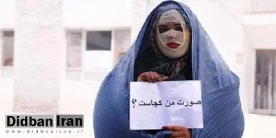 معروفترین قربانی اسیدپاشی: هنوز دیهام را نگرفتهام/ مجید ۷ سال زندان بود تا حکم قصاص را گرفتم