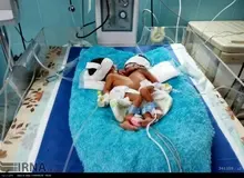 توضیحات رییس بیمارستان علوم پزشکی ایرانشهر درباره فوت دوقلوها: احتمال زنده بودنشان کم بود