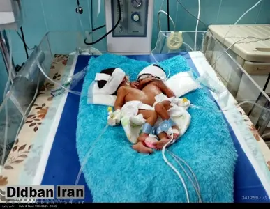توضیحات رییس بیمارستان علوم پزشکی ایرانشهر درباره فوت دوقلوها: احتمال زنده بودنشان کم بود