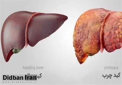 با داشتن این ۱۶ علامت به "کبد چرب" مبتلا هستید