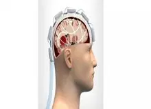 بررسی آسیب‌های سر با کلاه امواج مایکروویو