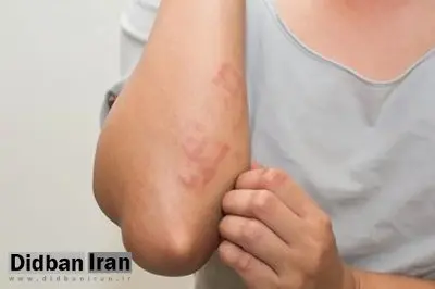 بیماری «سلیاک» چیست و چه علائمی دارد؟
