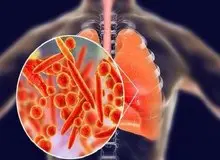 انسدادی مزمن ریه چهارمین علت مرگ‌ومیر جهان است