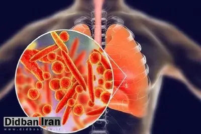 انسدادی مزمن ریه چهارمین علت مرگ‌ومیر جهان است