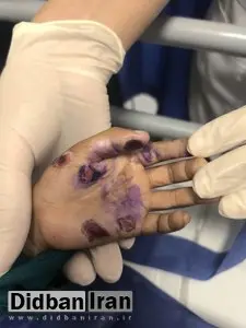 ماجرای مرگ کودک ۴ساله/ خانواده ادعا کرده‌اند؛ کودک از بالای درخت افتاده، اما کادر درمان از کودک آزاری خبر می دهند