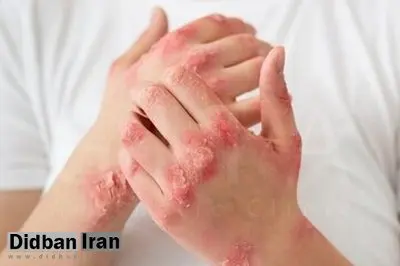 بیماری پسوریازیس و چه علائمی دارد؟