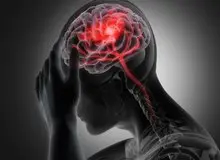 سکته مغزی دومین علت مرگ در ایران است
