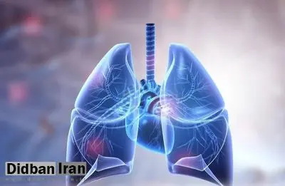 تأیید نخستین دارو برای بیماری مزمن ریوی
