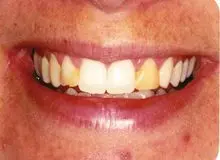 تغییر رنگ دندان ها