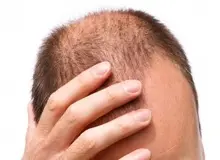 خوردن فست فود ارتباط مستقیمی با کم پشتی موها دارد