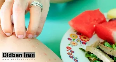 جلوگیری از بروز آلرژی غذایی با روش جدید ایمنیدرمانی