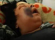 قارچ سیاه و نشانه های آن را بشناسید/FILM