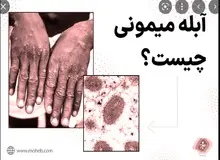 سازمان جهانی بهداشت شیوع «آبله میمون» را یک وضعیت اضطراری جهانی اعلام کرد 