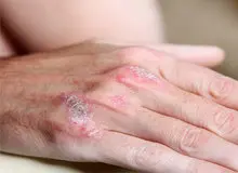 عواملی که سبب تشدید علائم پسوریازیس می شود