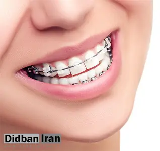 بعد از ارتودنسی دندان ها چه کنیم؟