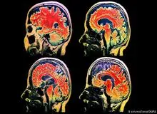 نتایج یک تحقیق در چین منتشر شد؛ مبتلایان به کرونا به مرور زمان دچار آسیب مغزی می شوند