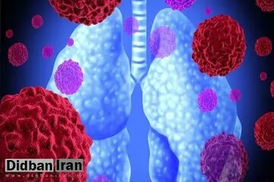 علت ۸۵ درصد سرطانهای ریه در ایران چیست؟